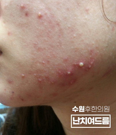 치료 전