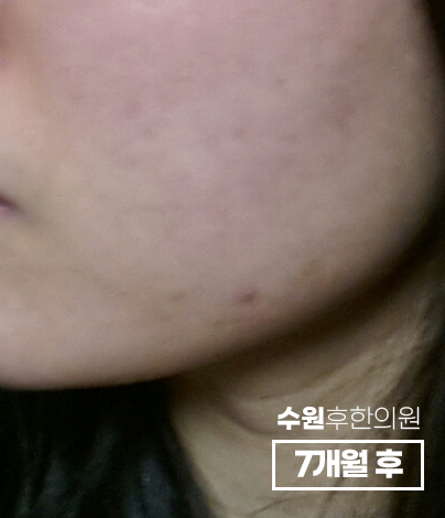 치료 후
