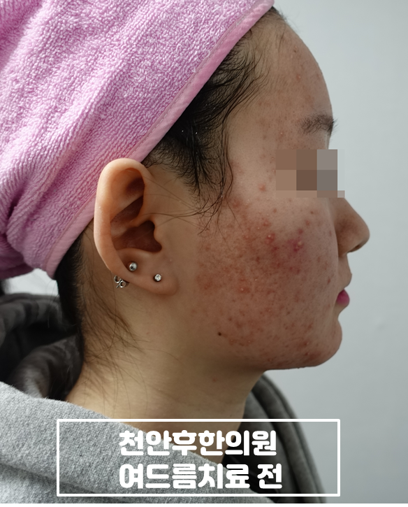 치료 전