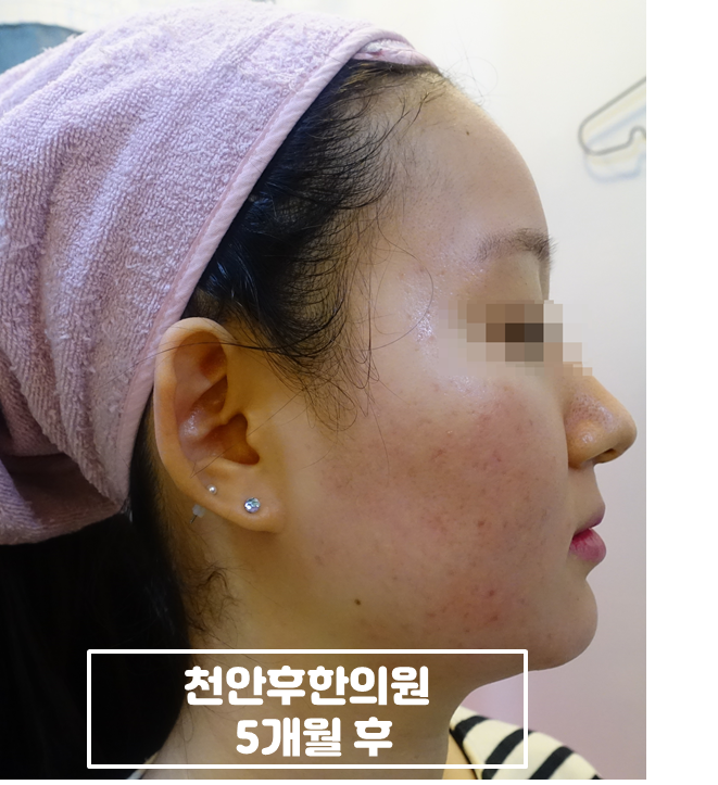치료 후