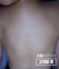 치료 후