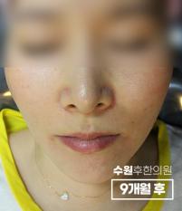 치료 후