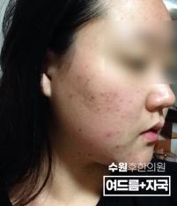 치료 전