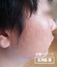 치료 후
