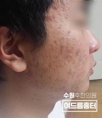 치료 전