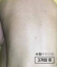 치료 후