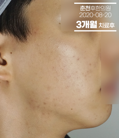 치료 후