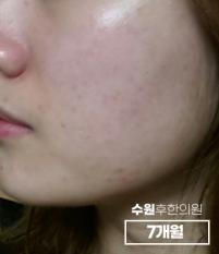 치료 후
