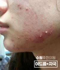 치료 전