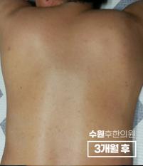 치료 후
