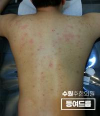 치료 전