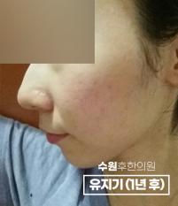 치료 후