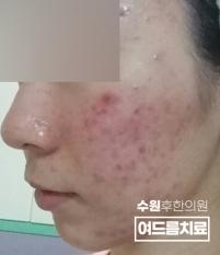 치료 전