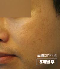 치료 후