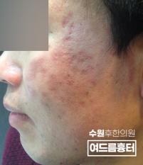 치료 전