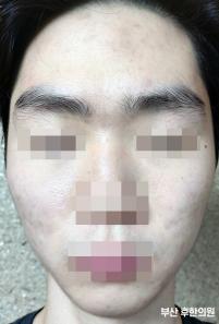 치료 후