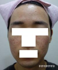 치료 후