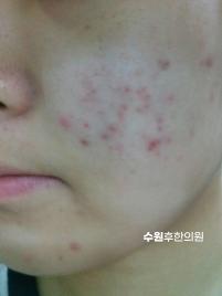 치료 전