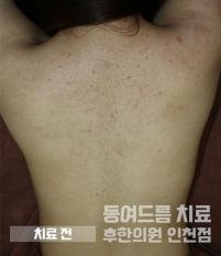 치료 전