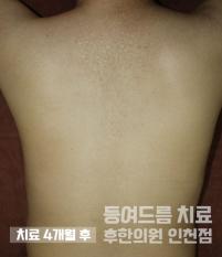 치료 후