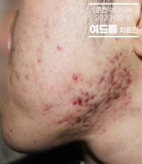 치료 전