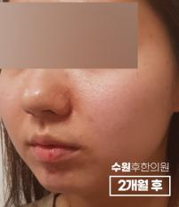 치료 후