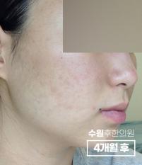 치료 후