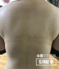 치료 후