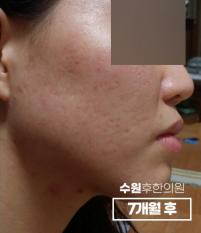 치료 후