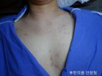 치료 전
