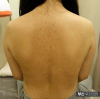 치료 후