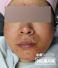 치료 전