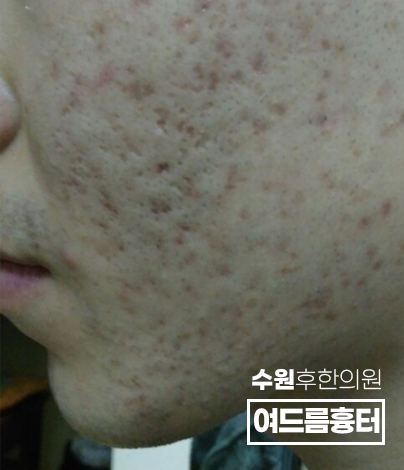 치료 전