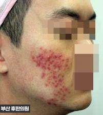 치료 전