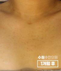 치료 후