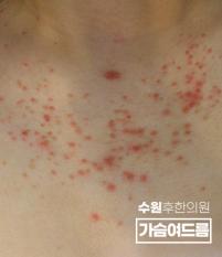 치료 전