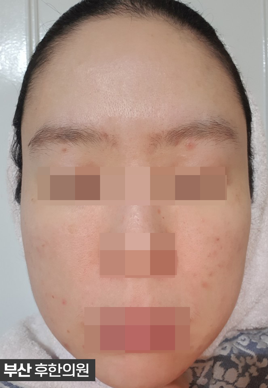 치료 후