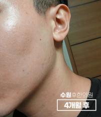 치료 후