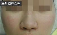 치료 후