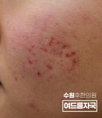 치료 전