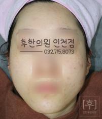 치료 후
