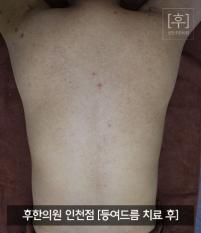 치료 후