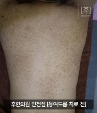 치료 전