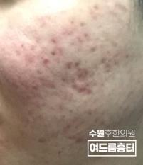 치료 전