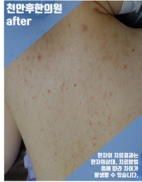 치료 전