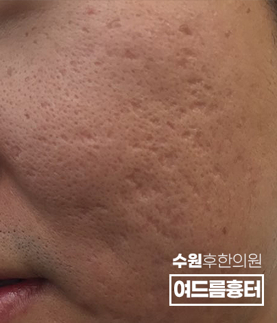 치료 전