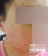 치료 전