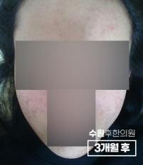 치료 후