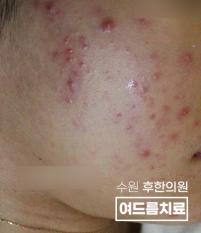 치료 전