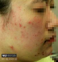 치료 전